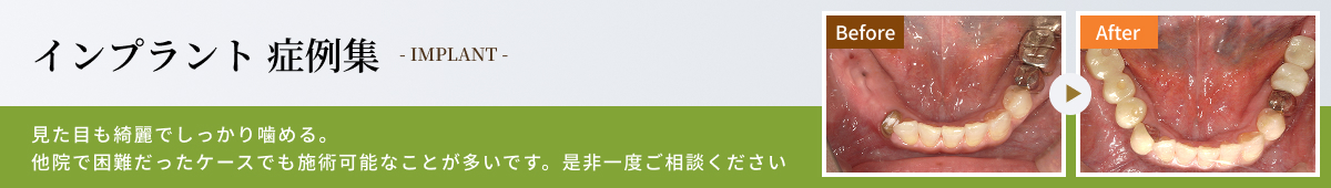 インプラント症例集