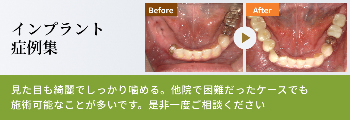 インプラント症例集
