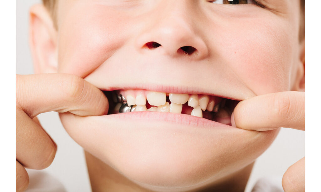 小学生くらいの男の子が自身の歯並びを見せているところ