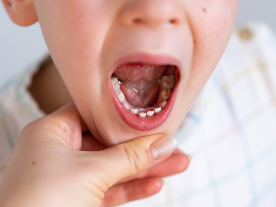 小児矯正について挿入イメージ