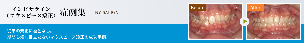 インビザライン症例集