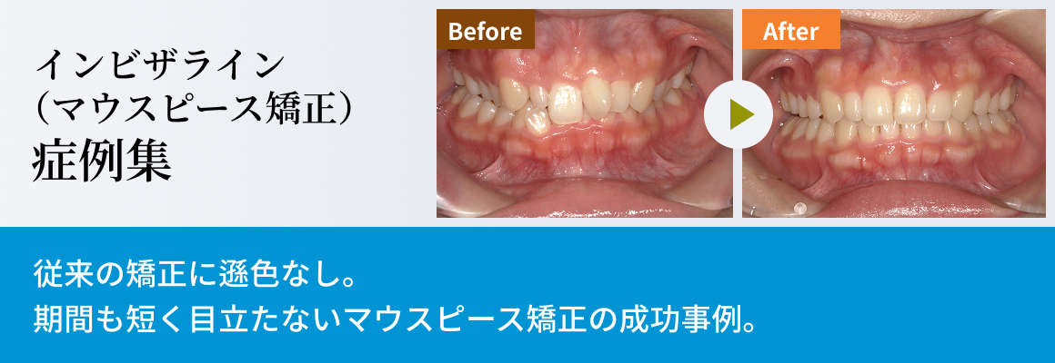 インビザライン症例集