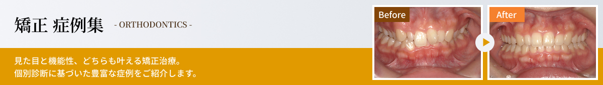矯正 症例集