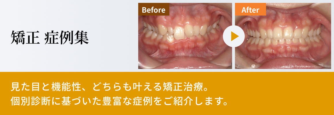 矯正歯科｜八幡市の歯医者さん｜あゆみ歯科クリニック松井山手