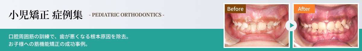 小児矯正症例集