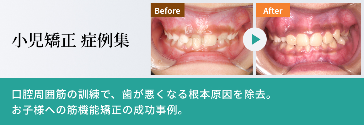 小児矯正症例集