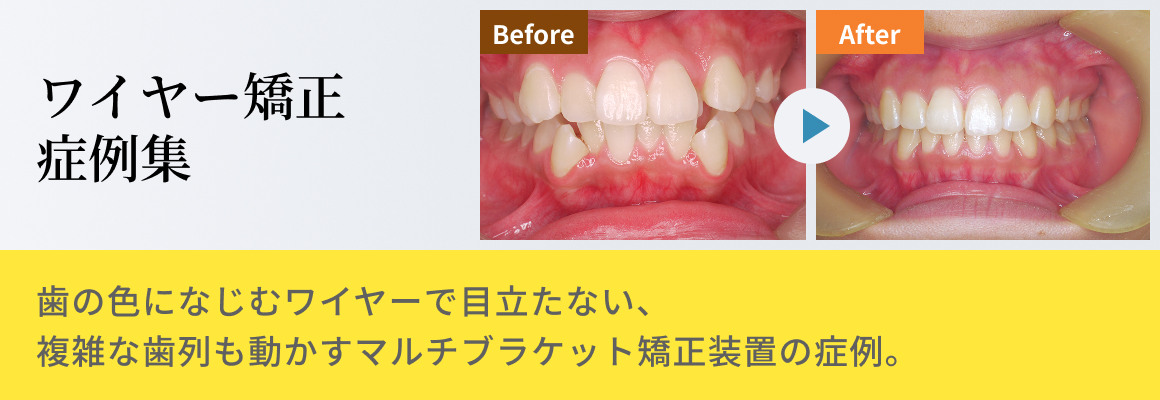 ワイヤー矯正症例集